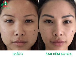 Tiem Botox Thon Gon Guong Mat (3)