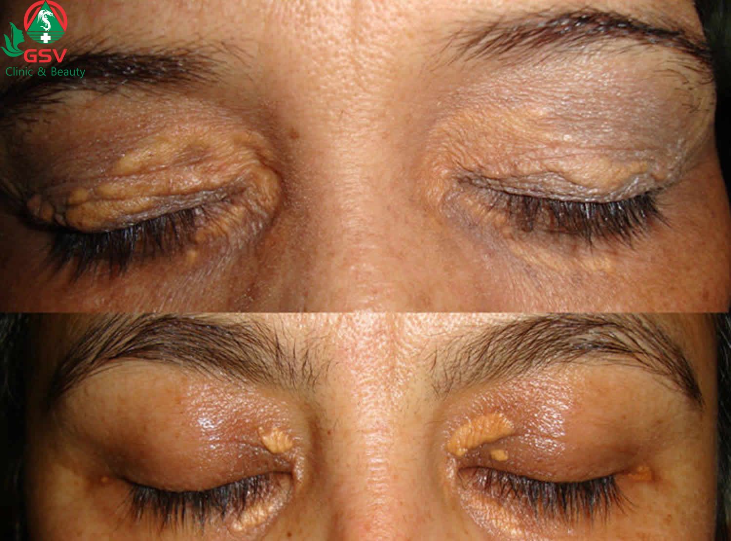 Hình ảnh bệnh u vàng tại vùng mắt