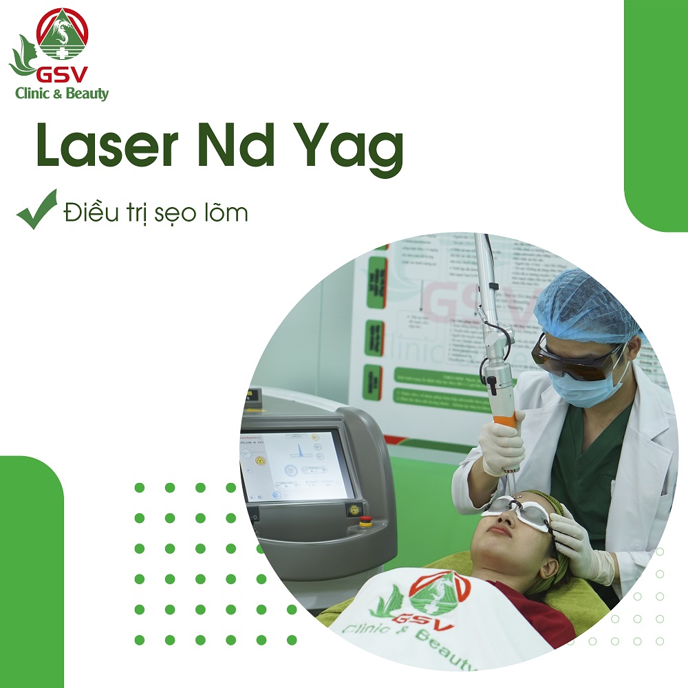 điều trị sẹo bằng Laser Nd Yag