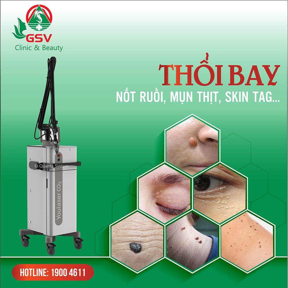Thoi Bay Not Ruoi Mun Thit Bang Laser Co2 (1)