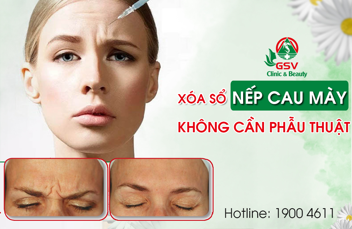 Tiem Botox Xoa Nep Nhan Cau May (1)