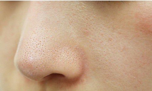 Mụn cám ở mũi và mặt khiến cho da trở nên sần sùi, mất thẩm mỹ