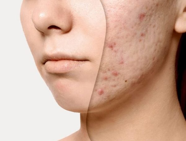 Da mặt sần sùi nhiều mụn cám ảnh hưởng tới chất lượng cuộc sống của nhiều người