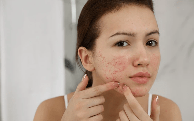 Làm sao để tránh việc nặn mụn gây tổn thương da? 
