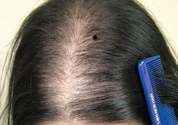 Nốt ruồi ở tóc mai nam nữ có ý nghĩa gì Tốt hay xấu