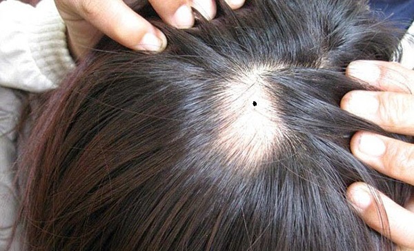 Luận giải ý nghĩa nốt ruồi trong tóc nam và nữ