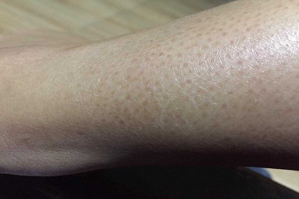 Viêm lỗ chân lông ở chân là tình trạng bệnh lý phổ biến